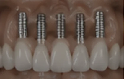 Oral implantology