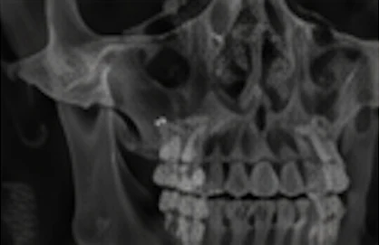 Orthognathic surgery