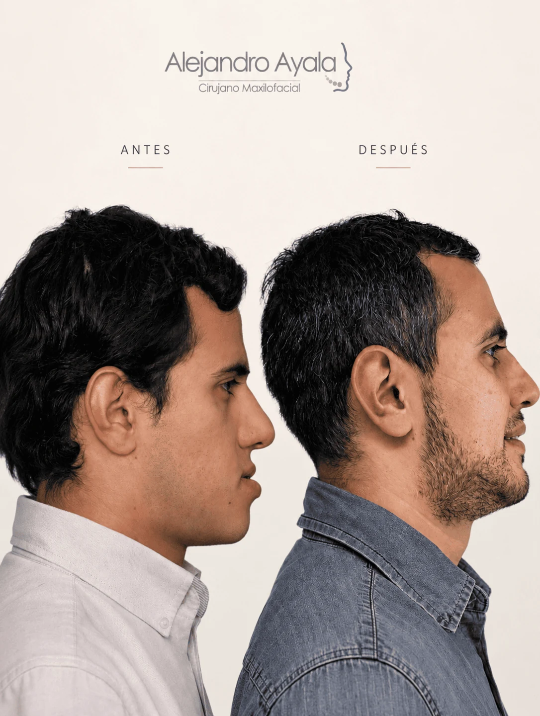 Profile view before and after bimaxillary orthognathic surgery