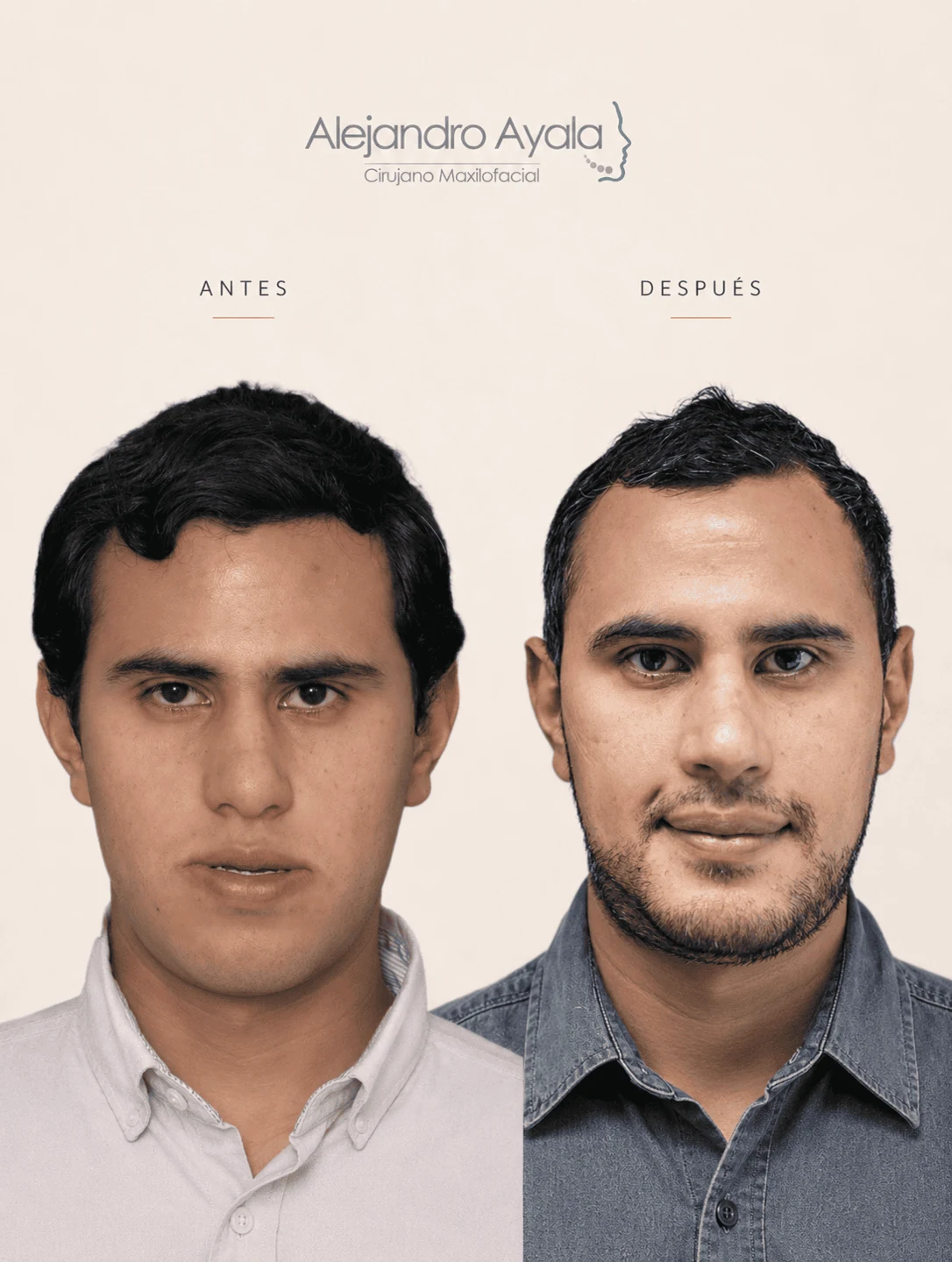 Frontal view before and after bimaxillary orthognathic surgery