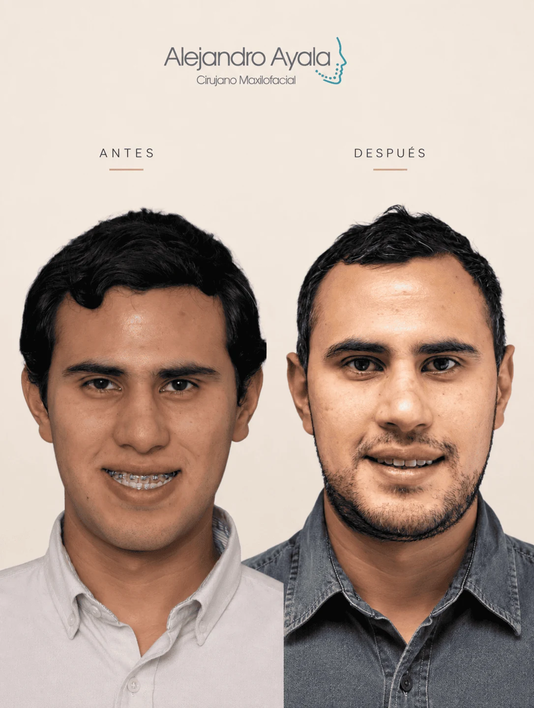 Smile before and after bimaxillary orthognathic surgery
