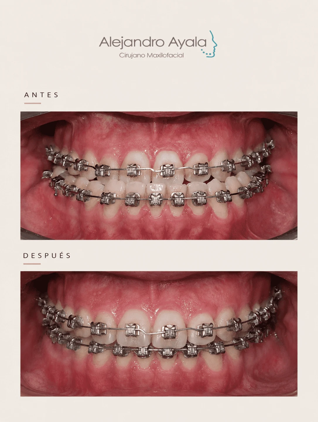 Occlusion before and after bimaxillary orthognathic surgery