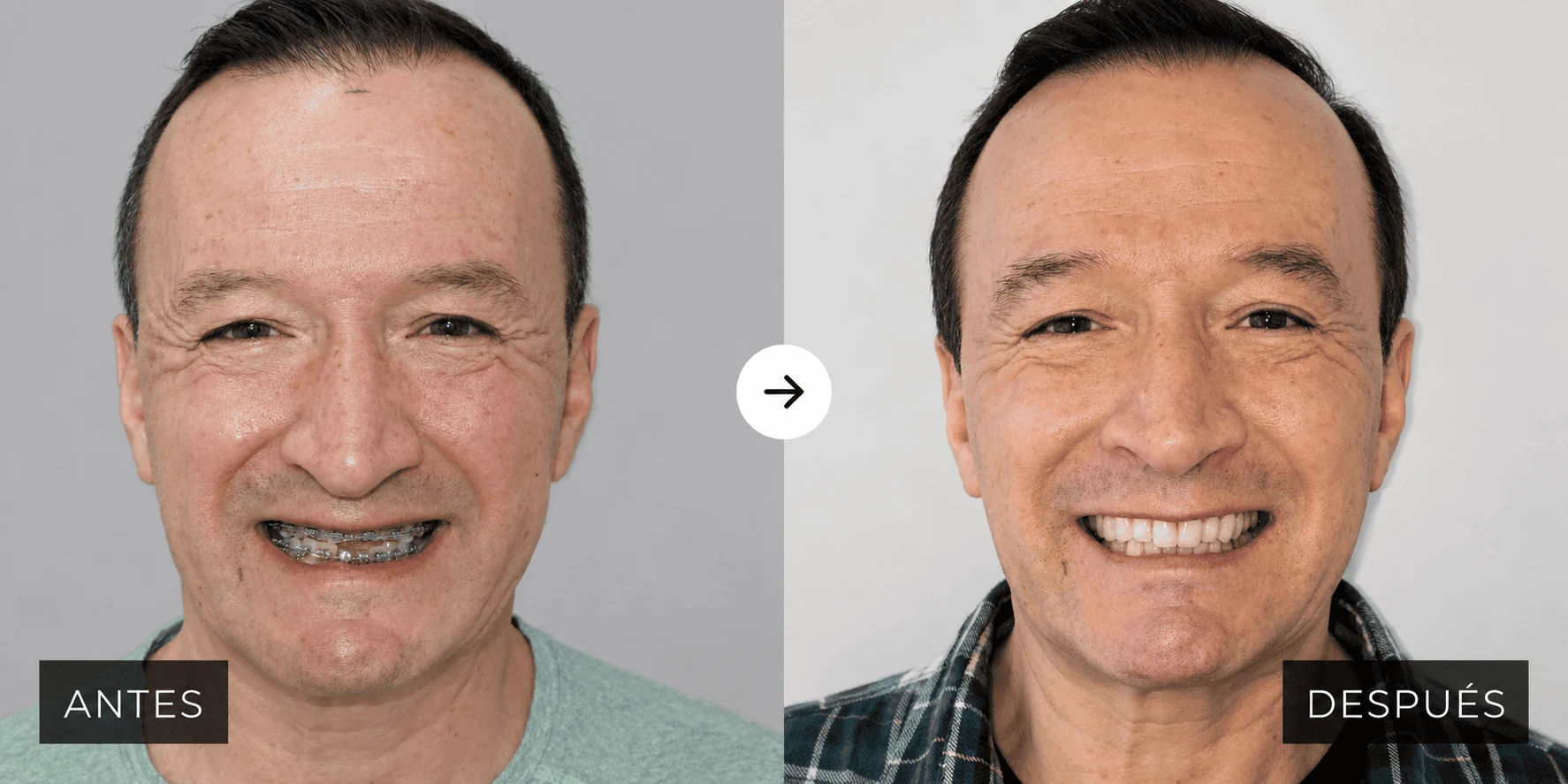 Implant-based reconstruction