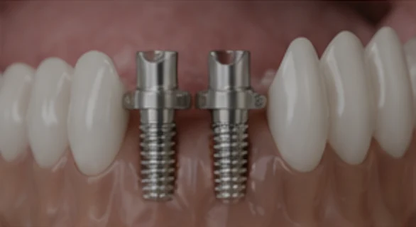 Implantología oral
